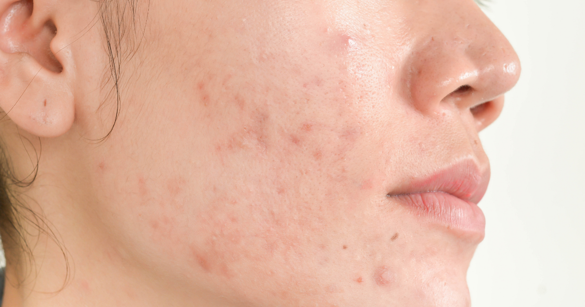 How to treat acne scars