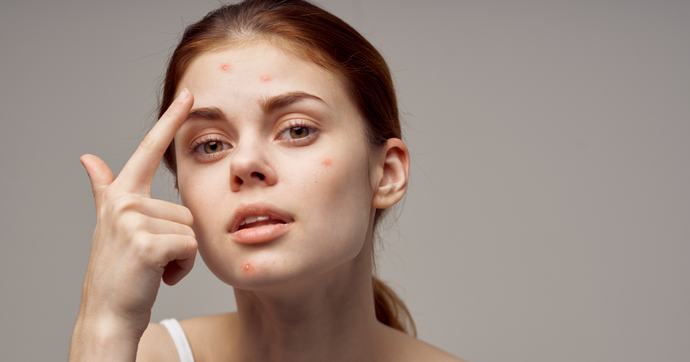 5 ways to get rid of pimples as fast as possible