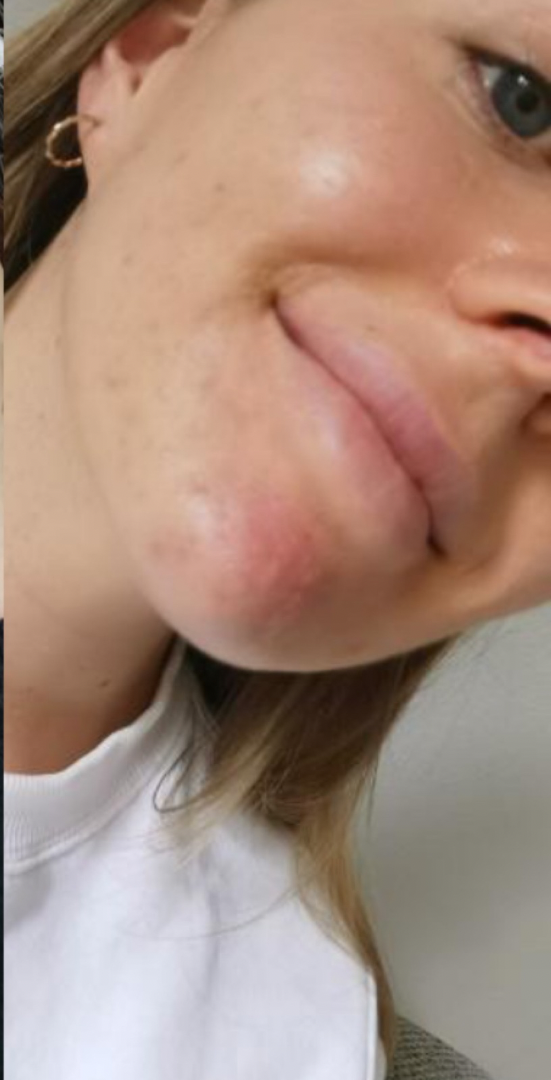 After skin result