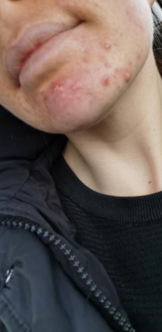 Before skin result