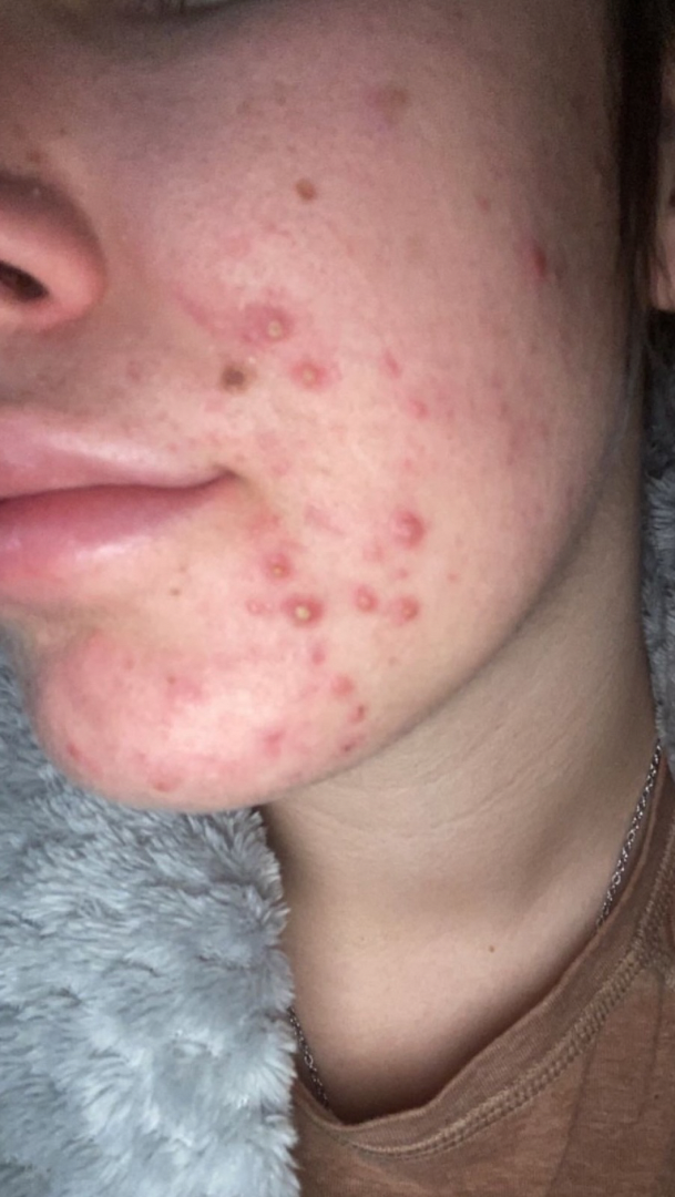 Before skin result