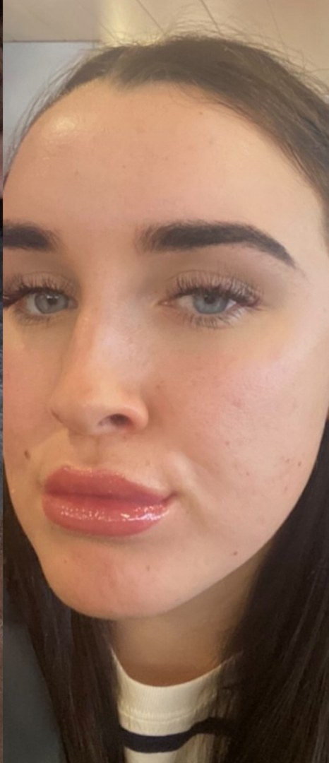 After skin result