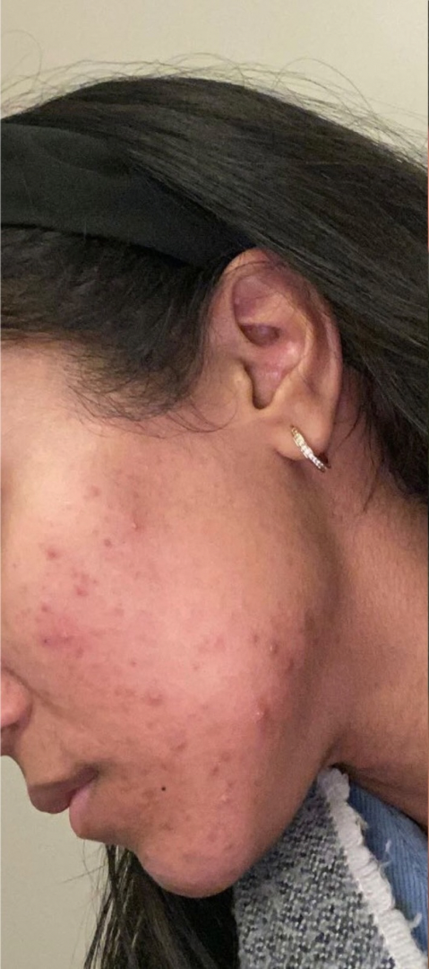 Before skin result