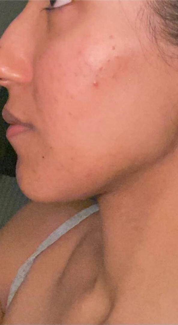 After skin result