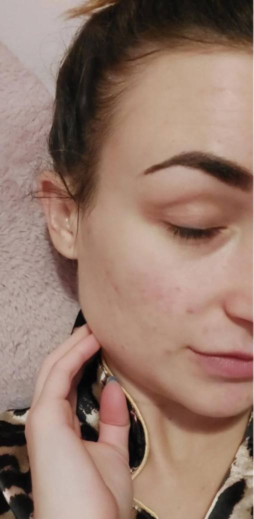After skin result