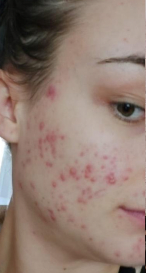 Before skin result