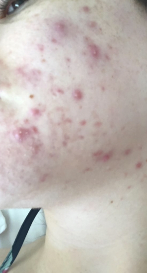 Before skin result