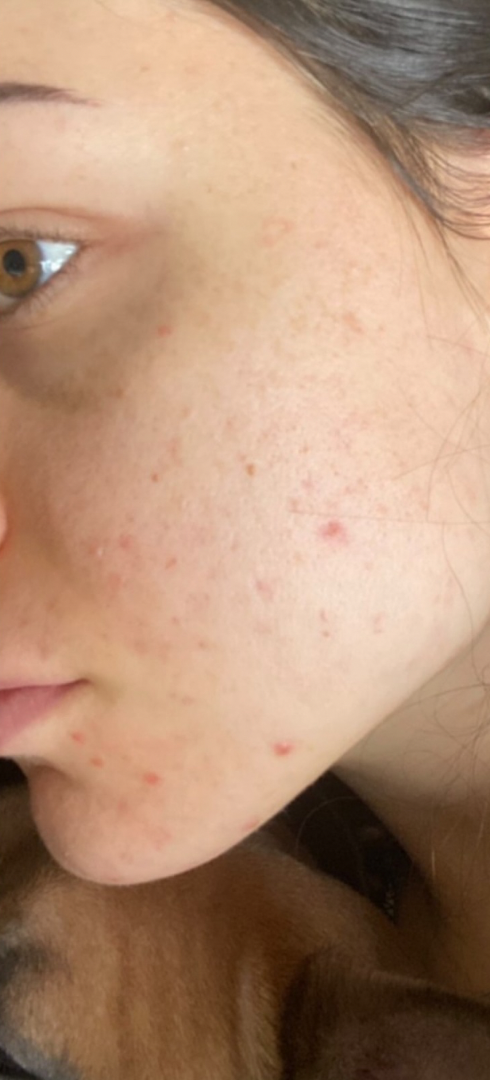 After skin result