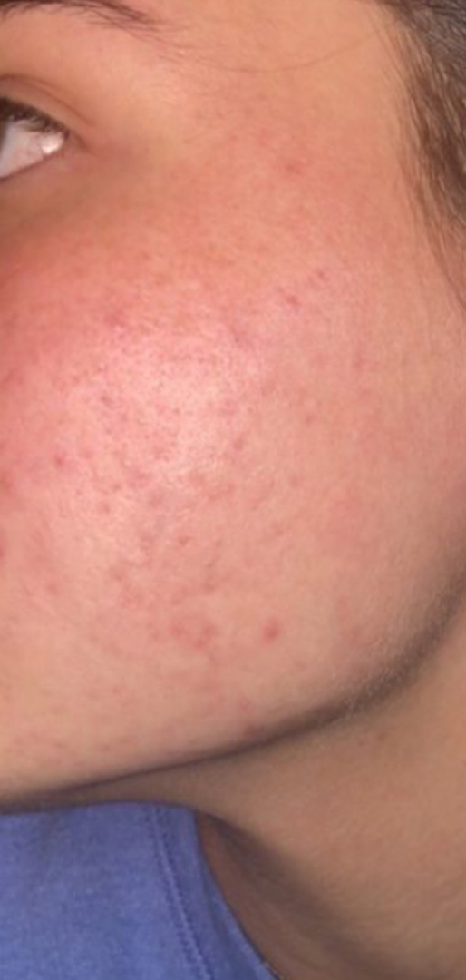 After skin result