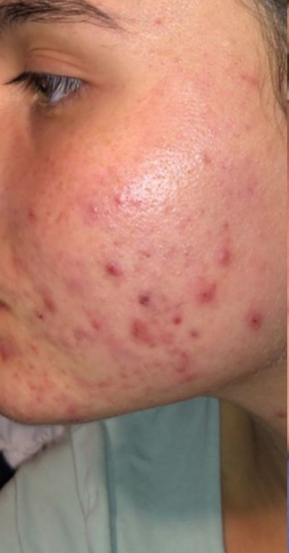Before skin result