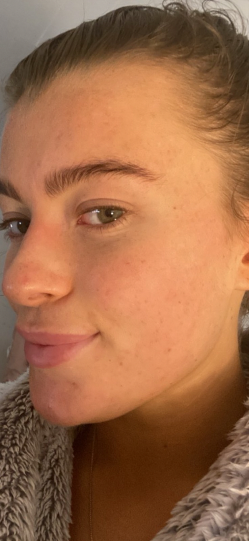 After skin result