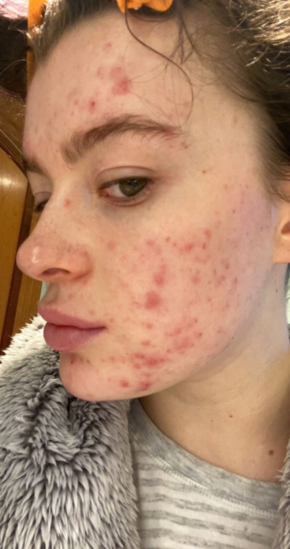 Before skin result