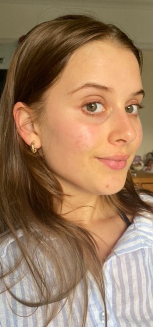 After skin result