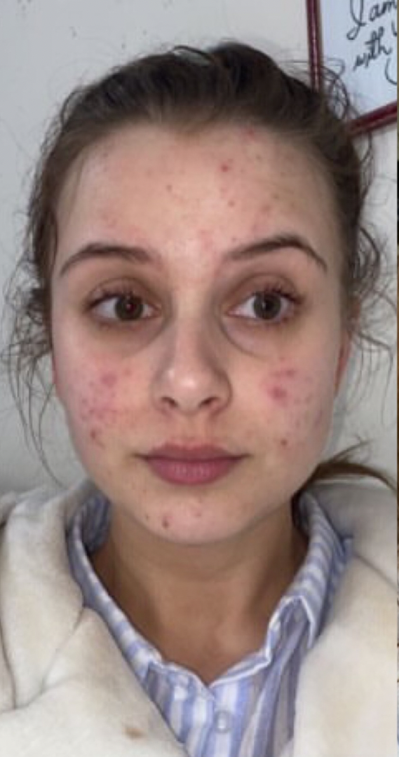 Before skin result