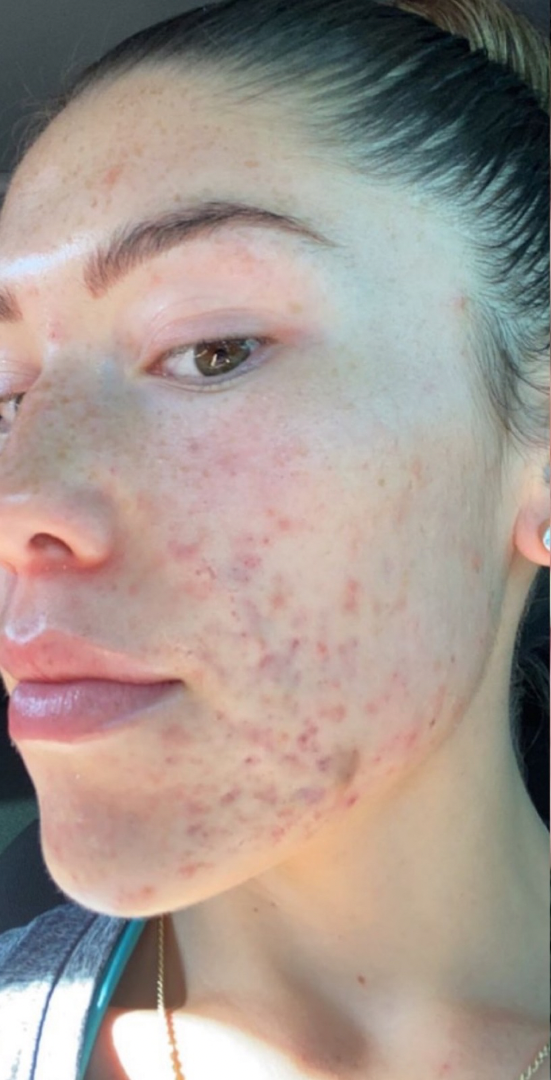 Before skin result