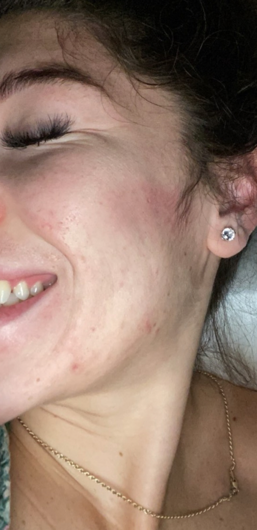 After skin result