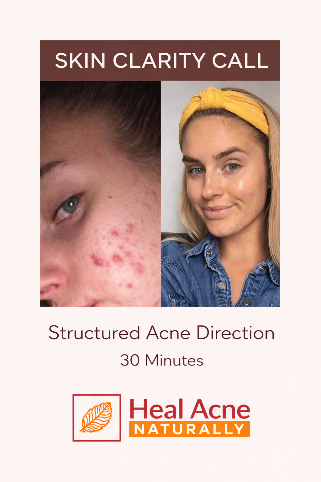 skin clarity call acne consultation session