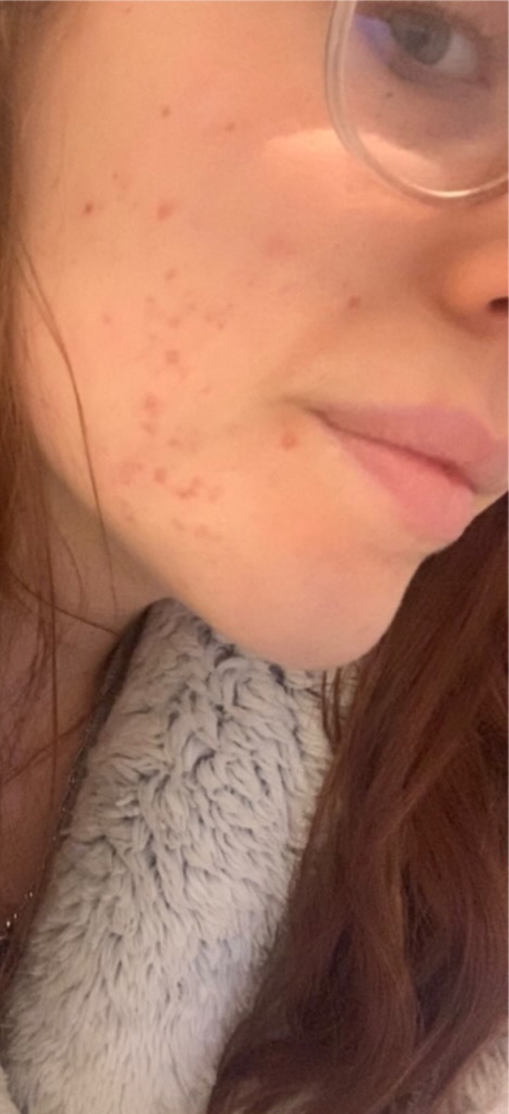 After skin result