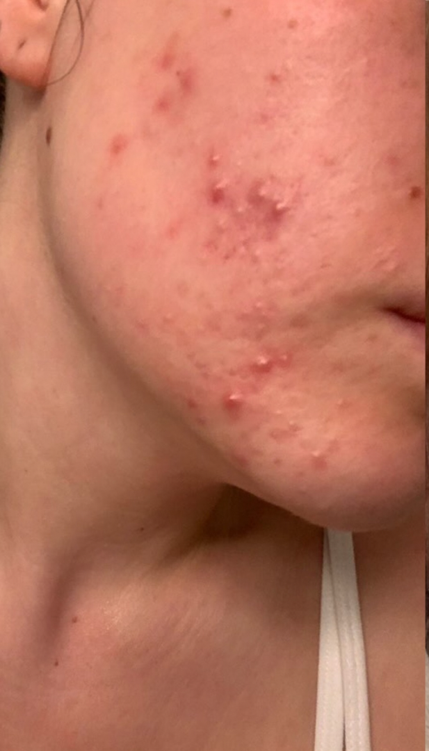 Before skin result