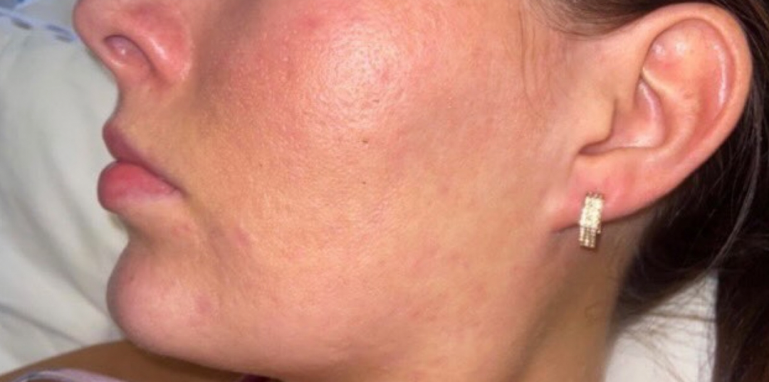 After skin transformation