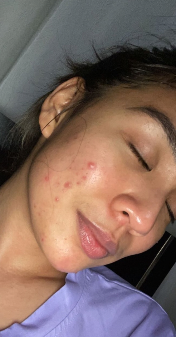 Before skin result