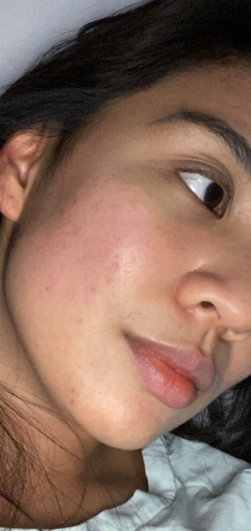 After skin result