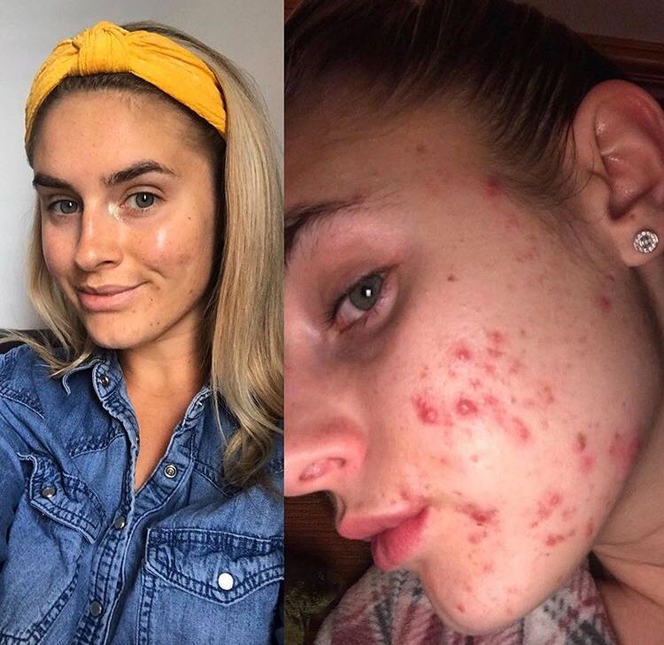 Heal Acne Naturally Cystic Hormonal Acne Treatment No Roaccutane